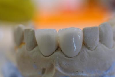 Zahnfarbener Zahnersatz - Veneers